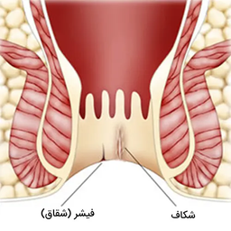 آیا شقاق مقعدی درمان دارد ؟