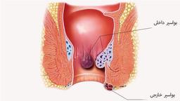انواع گرید 1،2،3،4 بواسیر داخلی و درمان