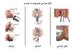 بهترین روش جراحی بواسیر چیست؟