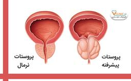 پروستات