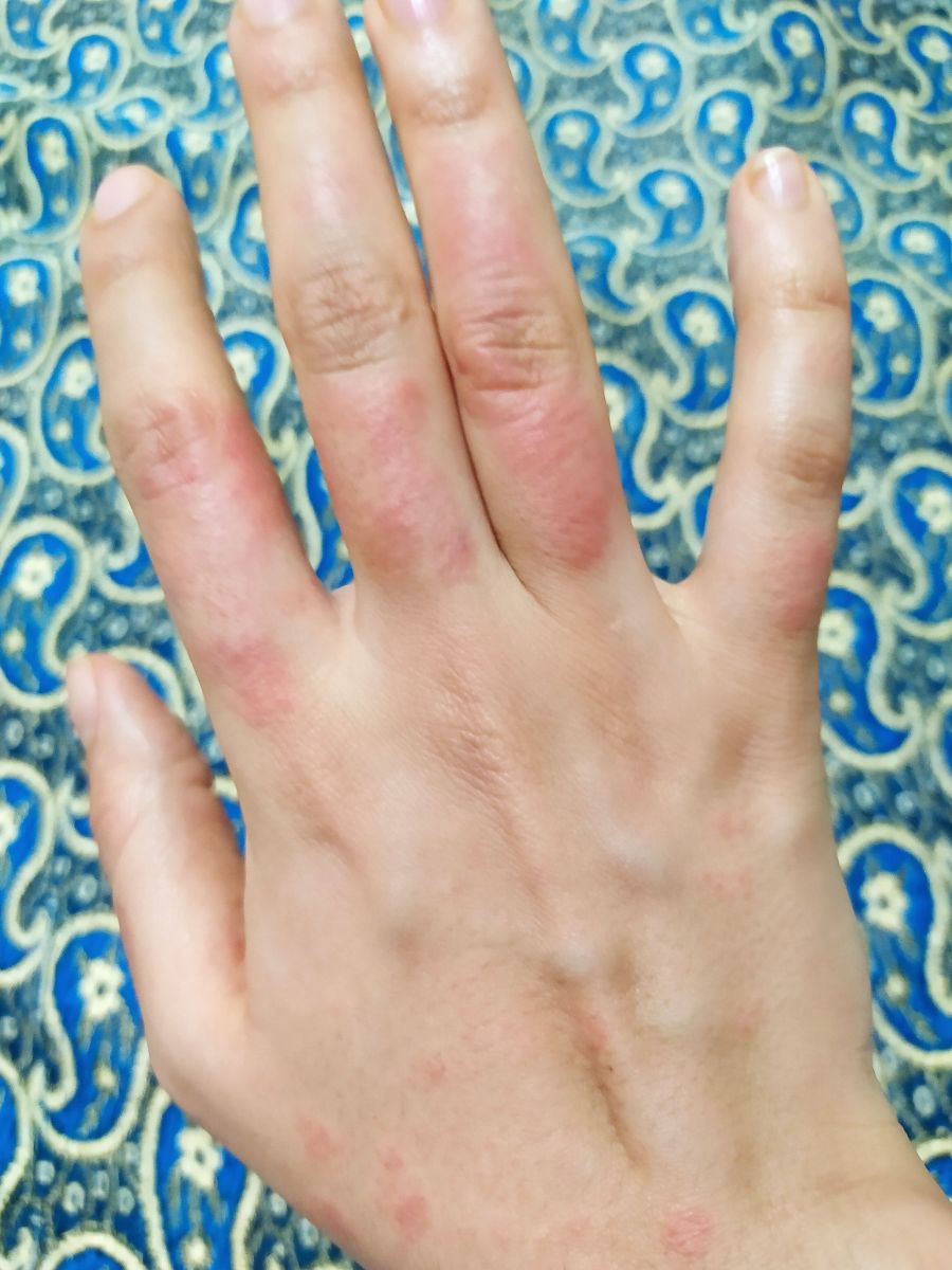 عکس از انگشت هام وقتی تازه شروع میشه به حساسیت