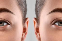 مدت زمان دوره نقاهت عمل بلفاروپلاستی