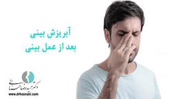 آبریزش بینی بعد از عمل بینی