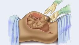 مقایسه زایمان طبیعی و سزارین