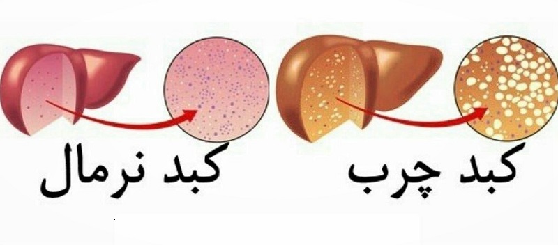 درمان کبد چرب