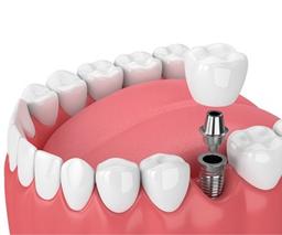 سؤالات متداول ایمپلنت دندان