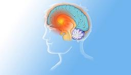 5 راه درمان میگرن و مقایسه آنها