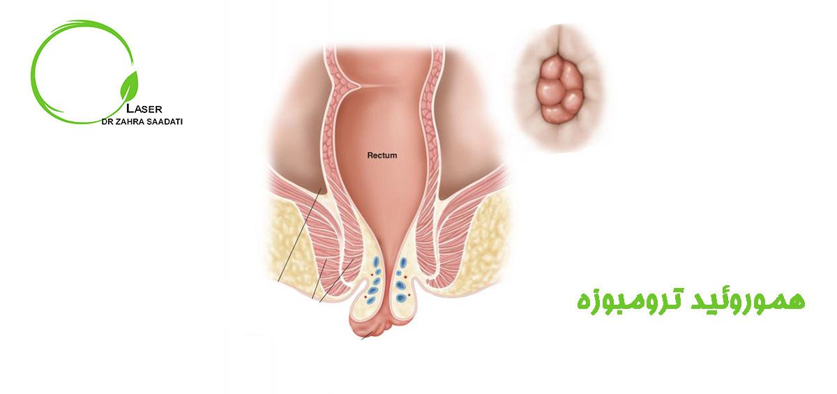 هموروئید یا بواسیر
