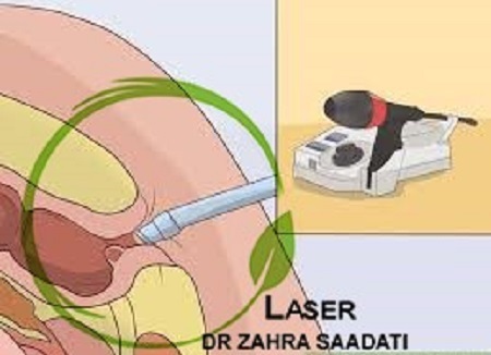 لیزر بواسیر