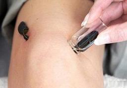 تأثیرات زالو درمانی