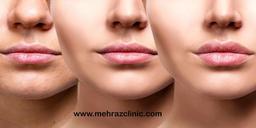 فیلر لب روسی+ تزریق فیلر لب مناسب چه کسانی است؟