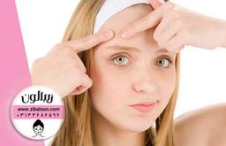 بهترین راهکارهای طب سنتی در درمان جوش صورت