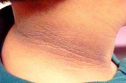 مشکلات پوستی به عنوان یکی از عوارض دیابت را بیشتر بشناسیم.