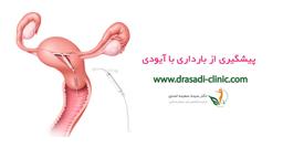 جلوگیری از بارداری با آیودی (IUD)