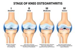 آرتروز زانو چیست