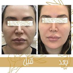 بهترین کلینیک برای هایفو و جوانسازی