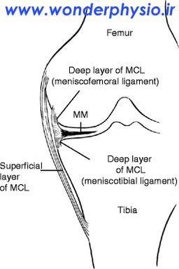 پارگی رباط طرفی داخلی (MCL)و اندیکاسیون های جراحی