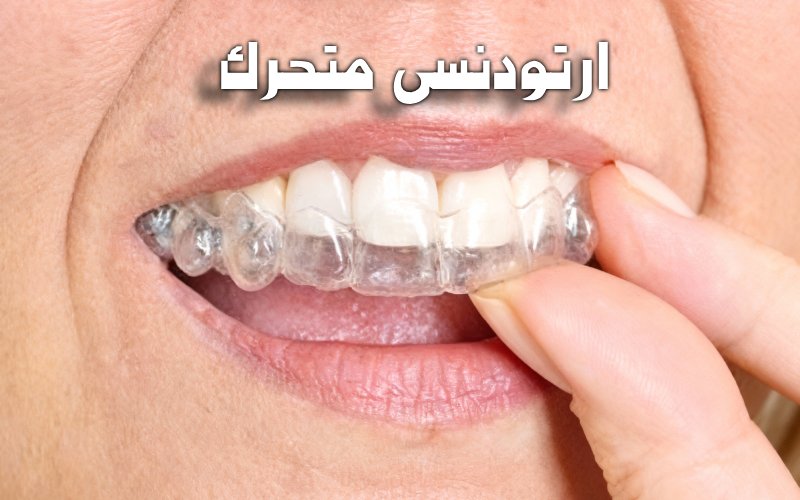 ارتودنسی متحرک