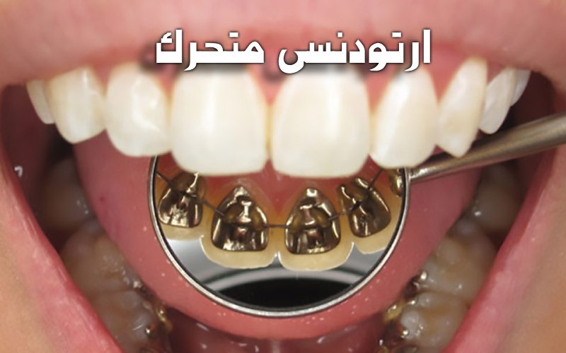 ارتودنسی لینگوال