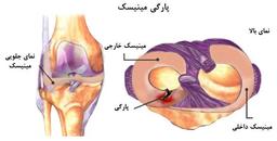 منظور از پارگی مینیسک چیست؟