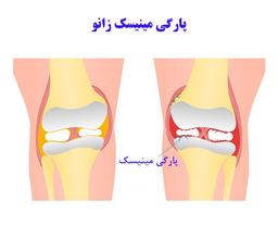 عمل پارگی منیسک