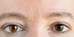 درماتیت سبورئیک ، علایم ، علل و درمان آن چیست؟