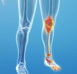 راهنمای تعویض مفصل زانو و لگن