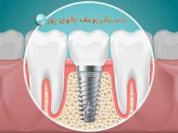 # ایمپلنت دندان و عوارض آن انجام دهیم یا نه؟