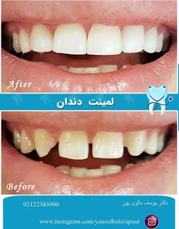 تفاوت بین کامپوزیت و لمینت