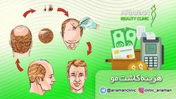 هزینه کاشت مو