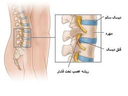 دانستنی های مهم درباره علل ابتلا به دیسک کمر