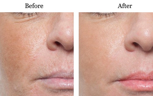 میکرونیدلینگ و هر آنچه که درباره مزایا و عوارض آن باید دانست