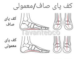 کف پای صاف(Flat Feet)