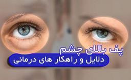 علت پف بالای چشم چیست؟ بررسی دلایل پف بالای چشم و راه های درمان آن