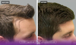 کاشت مو: راهنمای جامع برای درک روش، مزایا و خطرات