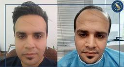 انتخاب بهترین کلینیک کاشت مو ایران توسط انجمن پیوند موی ایران