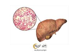 فواید آجیل برای کبد چرب