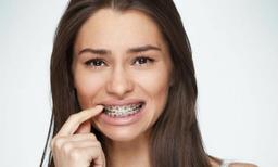 تاثیر ارتودنسی بر بینی، چند وقت بعد از عمل بینی می‌توان ارتودنسی کرد؟