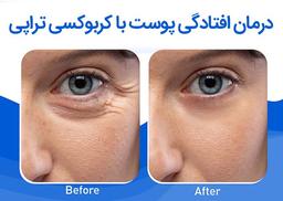 آیا کربوکسی تراپی می تواند پوست را سفت کند؟