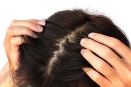 تفاوت شوره سر و خشکی پوست سر