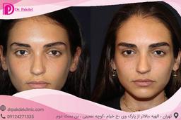 مراحل انجام کاشت ابرو طبیعی