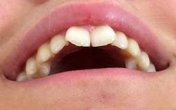 کامپوزیت دندان خرگوشی چگونه است؟ درمان دندان خرگوشی