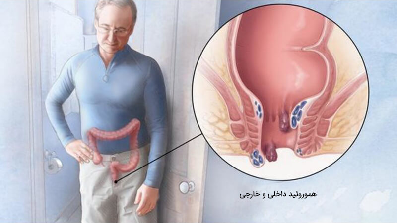 درمان بواسیر