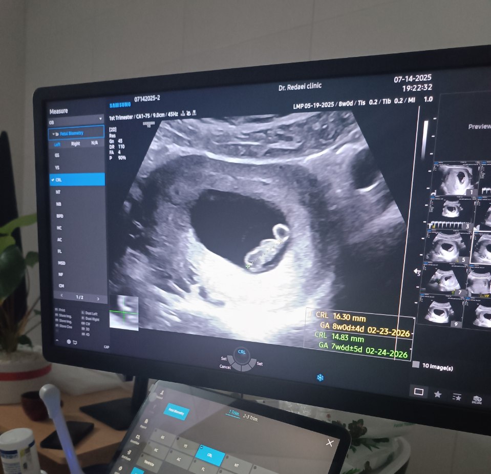 سونو هفته هشتم و اولین باری که صدای قلبشو شنیدم.