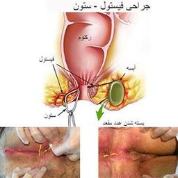 فیستول مقعد