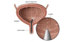 اثربخشی تزریق بوتاکس در مثانه