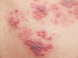 آکنه چیست و چگونه درمان می شود؟