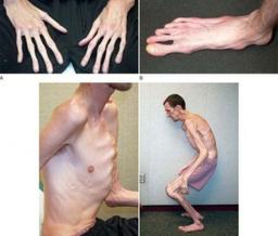 سندروم مارفان