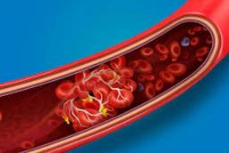 ترومبوز ورید عمقی ( Deep Vein Thrombosis )