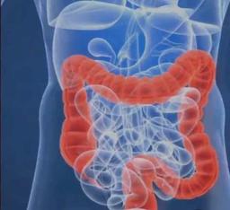 روده‌ تحریك‌پذیر و درمان آن